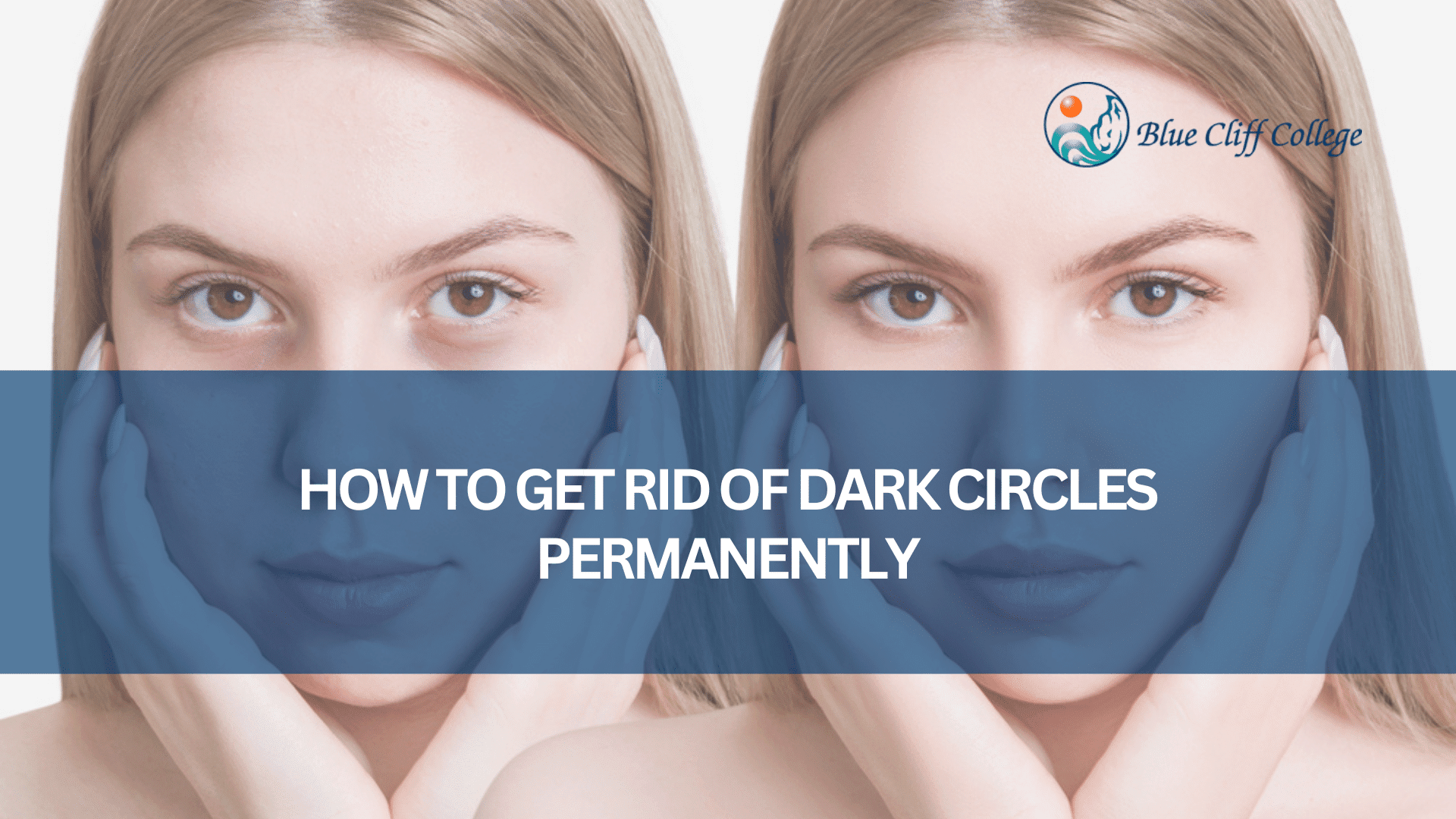 Read more about the article How To Get Rid of Dark Circles Permanently